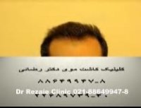 روش ترکیبی در کاشت موی طبیعی - 3