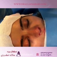 فیلم جراحی بینی با انحراف بسیار شدید