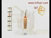 کاشت مو به روش انحصاری در کلینیک تخصصی رنسانس