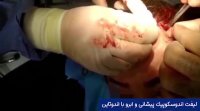 فیلم لیفت آندوسکوپیک ابرو و پیشانی با اندوتاین | پروفسور کشکولی | جراح پلک تهران