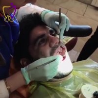 بازسازی دندان های شکسته به وسیله روکش | دکتر ندا هادی