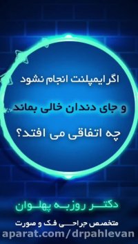 ضرورت انجام ایمپلنت دندان