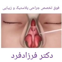 انیمیشن جراحی بینی