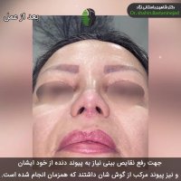 جراحی بینی ترمیمی پیچیده | دکتر باستانی نژاد | جراح بینی