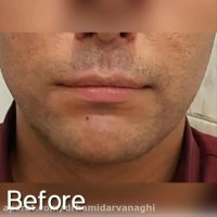 فیلم واقعی زاویه دار کردن صورت با تزریق فیلر فک