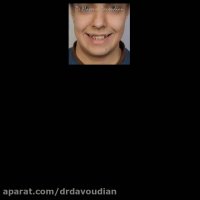 قبل و بعد ارتودنسی بدون کشیدن دندان | دکتر داوودیان