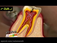 عوامل مؤثر در پوسیدگی دندان