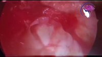 فیلم واقعی جراحی پولیپ بینی