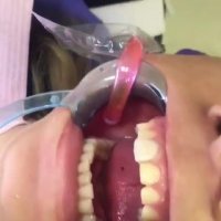 فیلم چسباندن لمینیت سرامیکی روی دندان توسط دکتر فرزانه فرخ نژاد