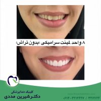 8 واحد لمینیت سرامیکی فک بالا