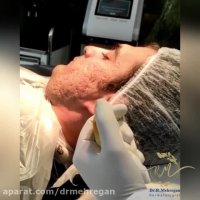 انجام پانچ الویشن جهت درمان اسکارهای آکنه (جای جوش های قدیمی)