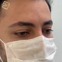 سوپر کاشت مو کلینیک رنسانس