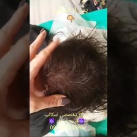 رفع کم پشتی موها با روش نوین میکرواسکالپ