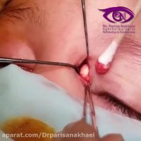 فیلم واقعی جراحی تومور درموئید در کودکان