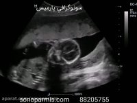 شیطنت جنین در شكم مادرش