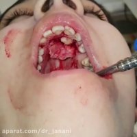 جراحی دندان نیش نهفته
