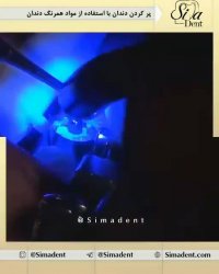 پرکردن دندان با مواد کامپوزیتی | دندانپزشکی سیمادنت