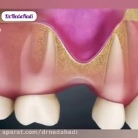 این افراد نباید ایمپلنت کنند!!!