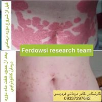 پسوریازیس یا صدف درمان شد ؟