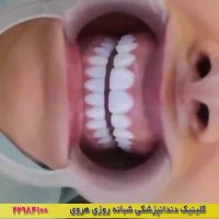 دندانپزشکی زیبایی و ونیر دندان