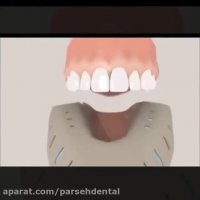 فیلم روکش دندان