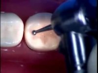 Composite Class I Restoration