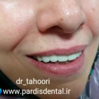 ایمپلنت فک بالا-مرکز فوق تخصصی پردیس