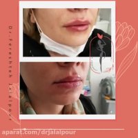 فیلم نکات مهم تزریق ژل به لب