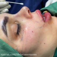 جراحی بینی با تزریق چربی لب گونه و شقیقه
