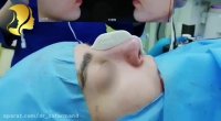 نمونه جراحی زیبایی بینی بلافاصله بعد از عمل