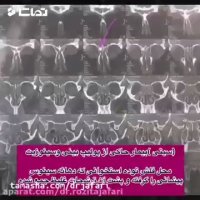 استئوم سینوس فرنتال(پولیپ بینی و سینوزیت)