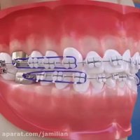 نحوه قرار دادن براکت یا باندینگ در ارتودنسی