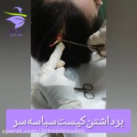 کیست سبابه