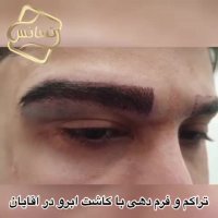 فیلم کاشت ابرو - کلینیک تخصصی رنسانس
