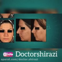 فیلم قبل و بعد از جراحی بینی