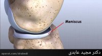 منیسک های زانو