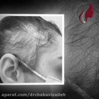 فیلم واقعی کاشت مو برای خانم ها در شرایط خاص