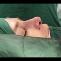 فیلم جراحی زیبایی بینی