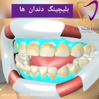 نحوه بلیچینگ دندان