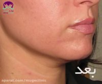 مزوتراپی از بین بردن غبغب