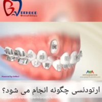 فیلم نحوه ی کارگذاشتن ارتودنسی دندان