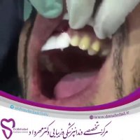 مراحل چسباندن ونیرهای لومینییرز