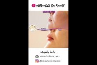 فیلم تزریق ژل لب_کلینیک تخصصی رنسانس