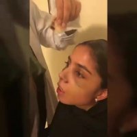 6 روز بعد از جراحی زیبایی بینی