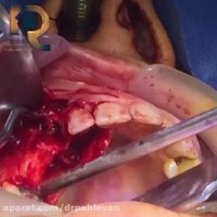 ضایعه پاتالوژیک در فک فوقانی