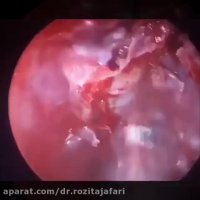 فیلم نمای مننگوسل با آندوسکوپ