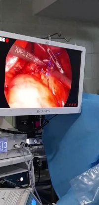 لایو اینستاگرام : جراحی چاقی بای پس کلاسیک در آقای 33 ساله با وزن 110 کیلوگرم