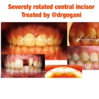 ارتودنسی:  چرخش شدید ثنایا