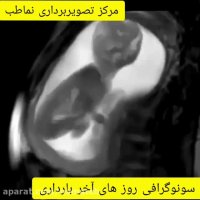 سونوکرافی روزهای آخر بارداری