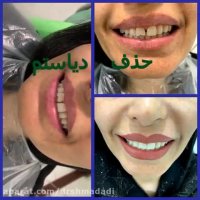 حذف فواصل بین دندانی